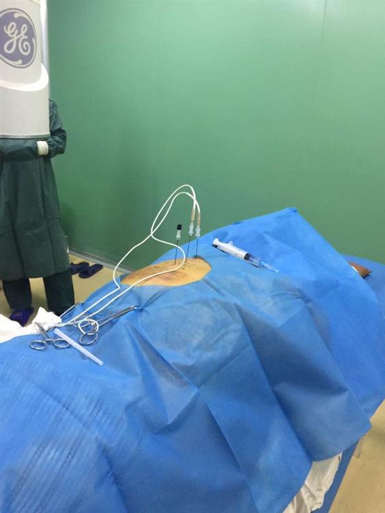 患者正在接受射频脉冲治疗,微创损伤小,效果确切!