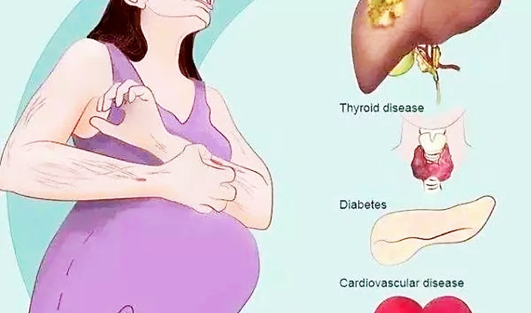 妊娠期肝内胆汁淤积症的健康宣教